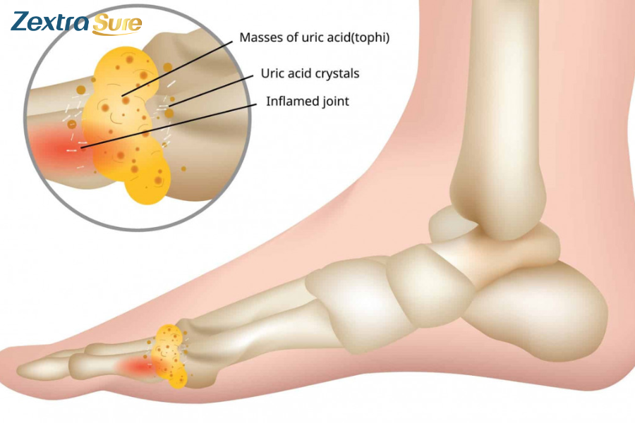 Gout is a type of arthritis caused by high levels of uric acid in the blood